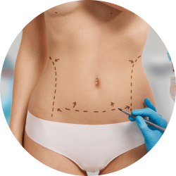 Абдоминопластика